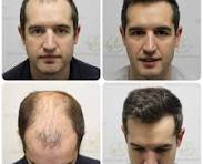 Revitalizing Your Look: Understanding Hair Transplants in Dubai