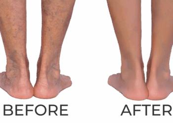 Top Varicose Vein Treatments – Expert Care, Beautiful Results