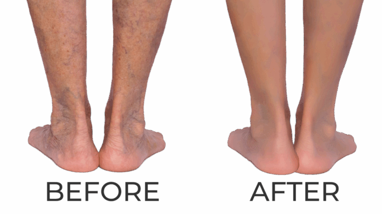 Top Varicose Vein Treatments – Expert Care, Beautiful Results