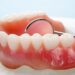 Your Guide to Denture Repairs on the Gold Coast