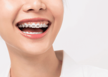 Types of Braces for a Modern Smile