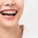 Types of Braces for a Modern Smile