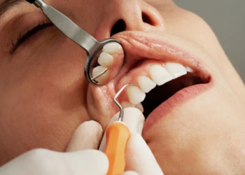 Dental Veneers: Beyond the Look – Fashion, Lifestyle, and Functional Benefits