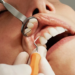 Dental Veneers: Beyond the Look – Fashion, Lifestyle, and Functional Benefits