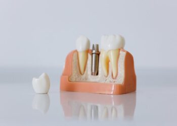 Understanding Your Options for Replacing Missing Teeth