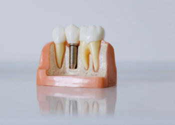What Really Happens When You Put Off Replacing a Missing Tooth
