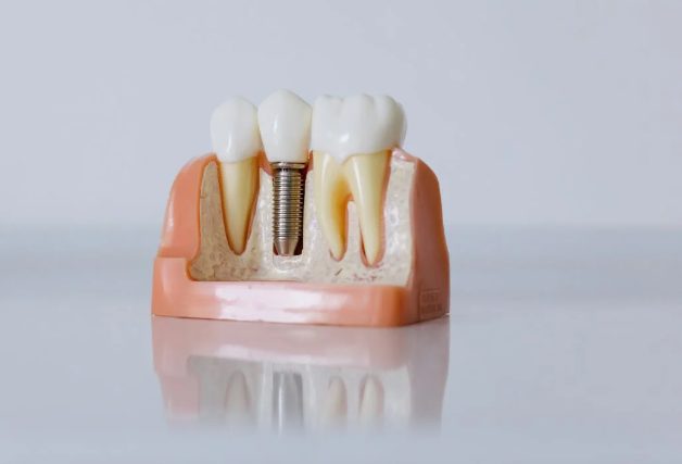 What Really Happens When You Put Off Replacing a Missing Tooth