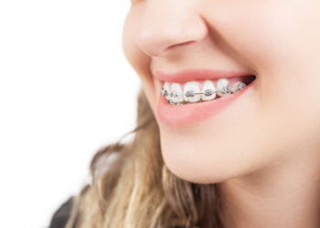 What to Expect with a Metal Orthodontic Bracket the First Time?