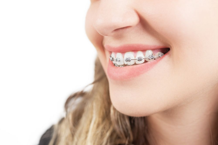 What to Expect with a Metal Orthodontic Bracket the First Time?
