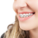 What to Expect with a Metal Orthodontic Bracket the First Time?