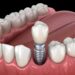 Dental